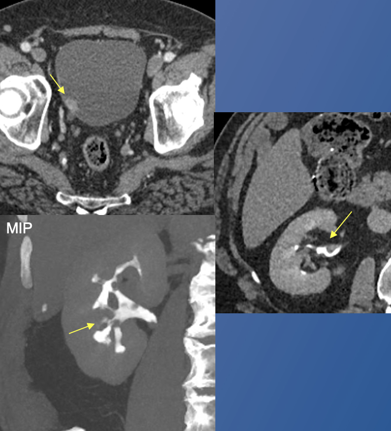 Renal Transitional Cell Carcinoma