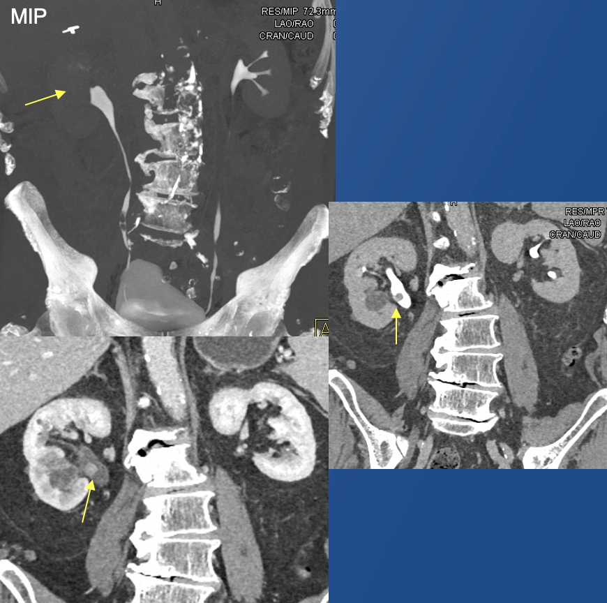 Renal Transitional Cell Carcinoma