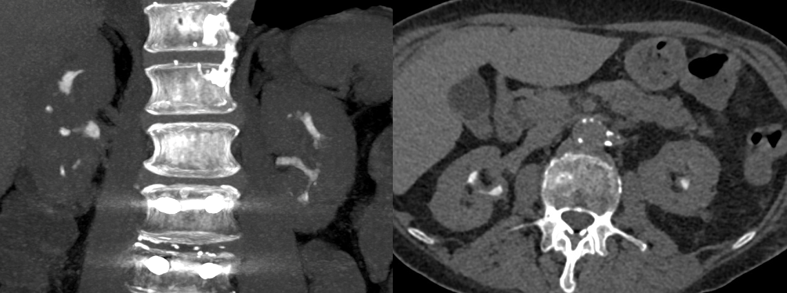 Renal Transitional Cell Carcinoma