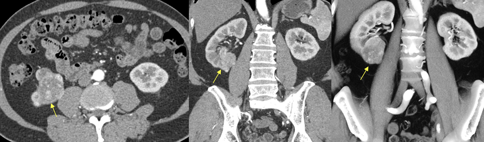 Renal Transitional Cell Carcinoma