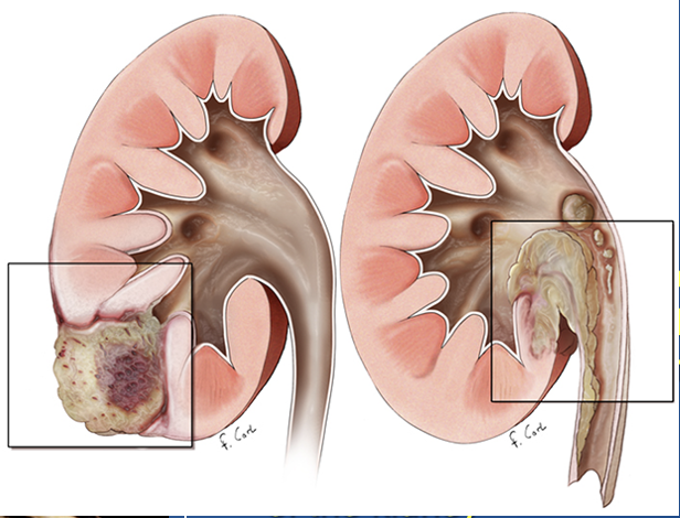 Renal Transitional Cell Carcinoma