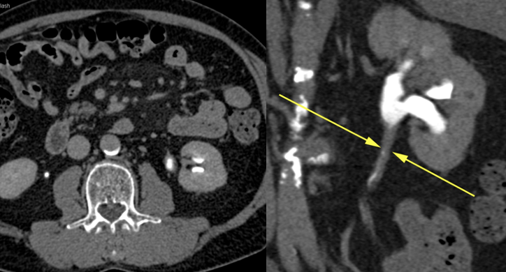 Renal Transitional Cell Carcinoma