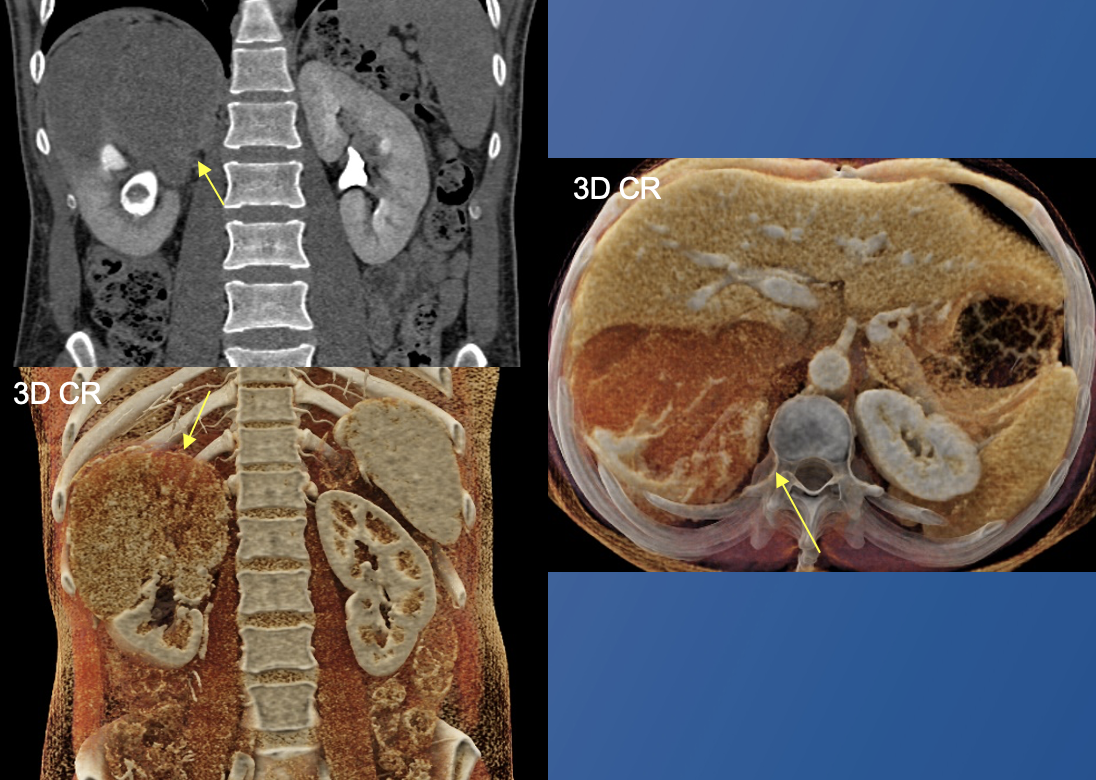 Renal Transitional Cell Carcinoma