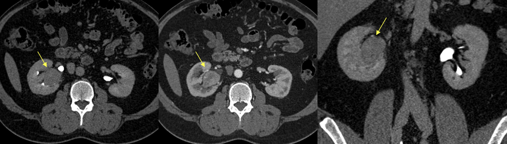 Renal Transitional Cell Carcinoma