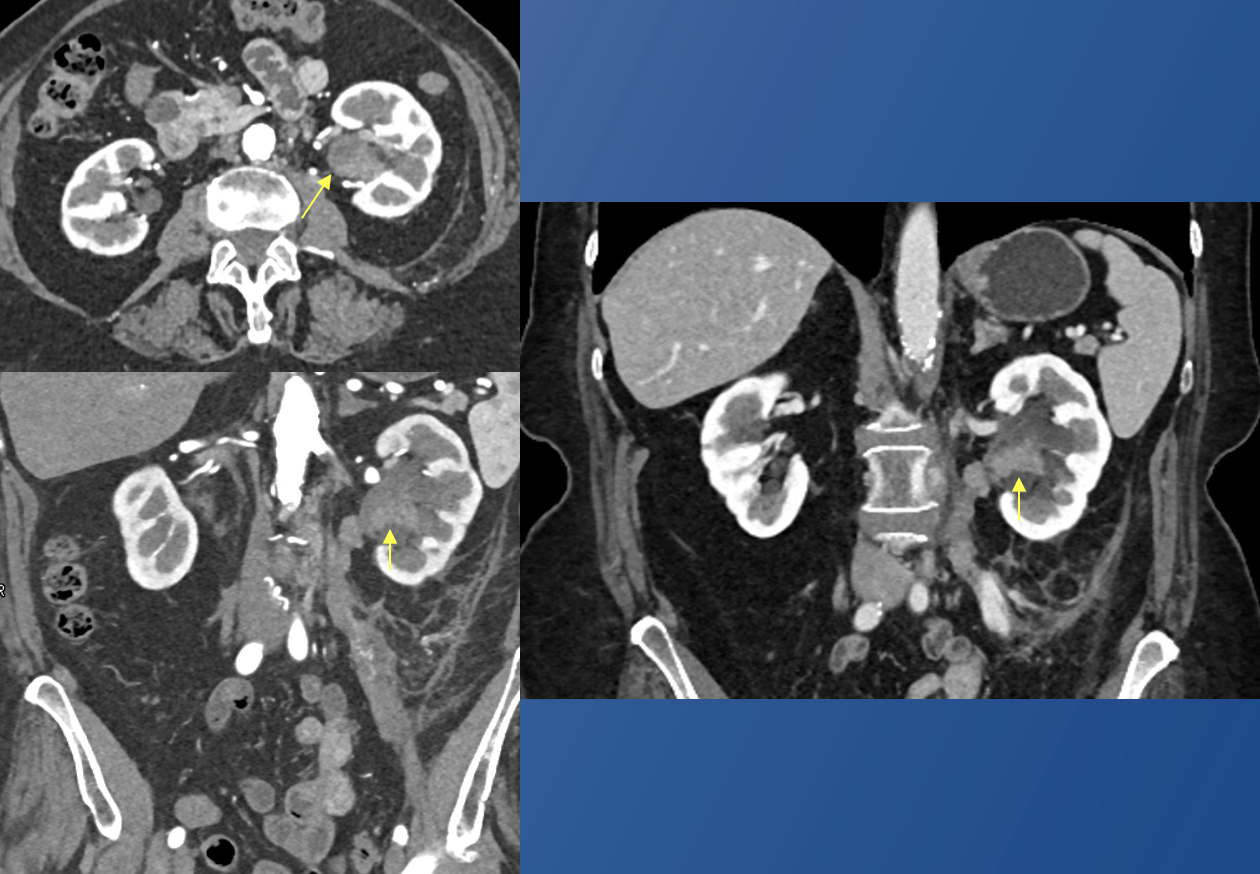 Renal Transitional Cell Carcinoma