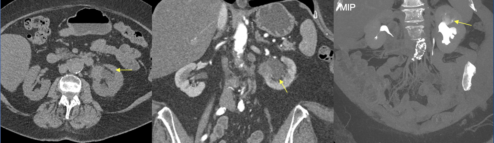 Renal Transitional Cell Carcinoma