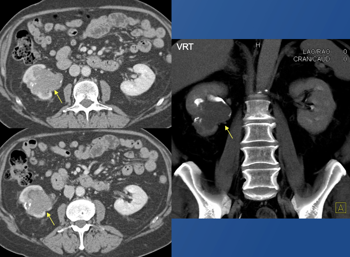 Renal Transitional Cell Carcinoma