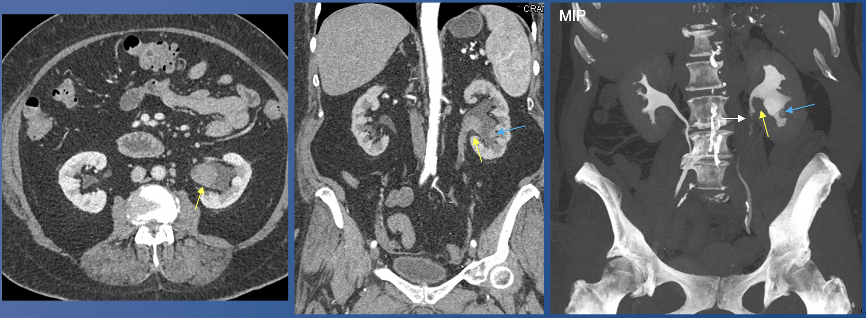 Renal Transitional Cell Carcinoma