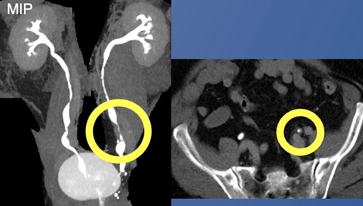 Renal Transitional Cell Carcinoma
