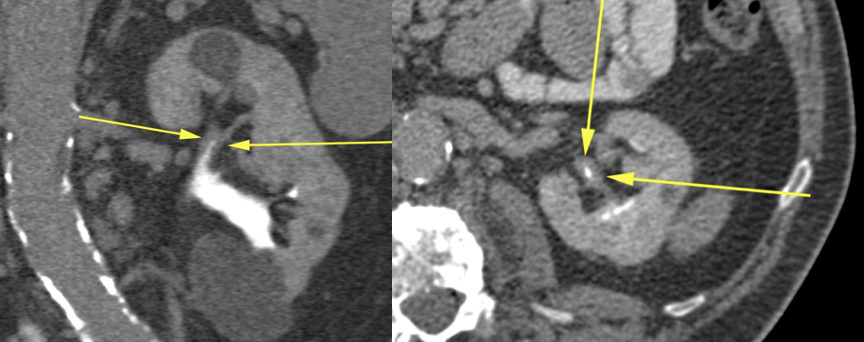 Renal Transitional Cell Carcinoma