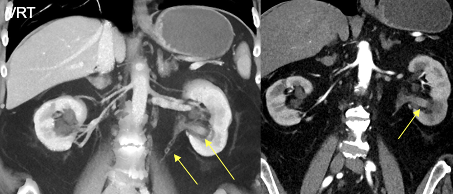 Renal Transitional Cell Carcinoma