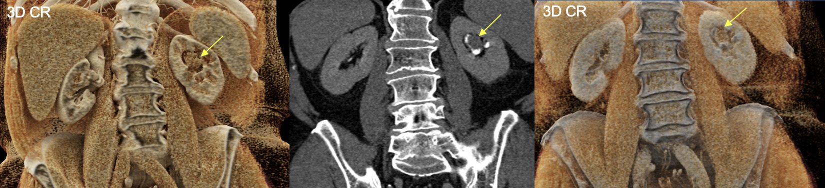 Renal Transitional Cell Carcinoma