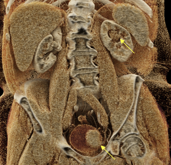 Transitional Cell Carcinoma