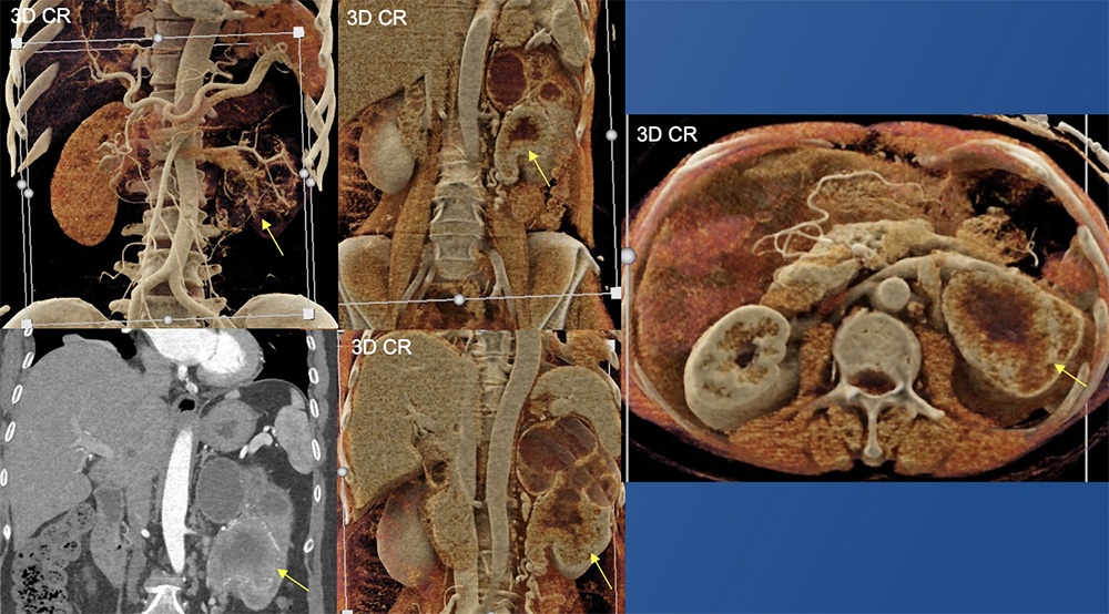 Transitional Cell Carcinoma