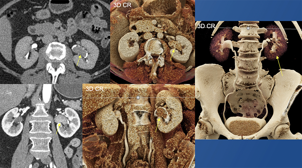 Transitional Cell Carcinoma