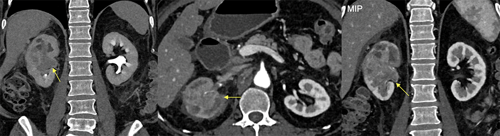 UTUC as infiltrative mass on CTU