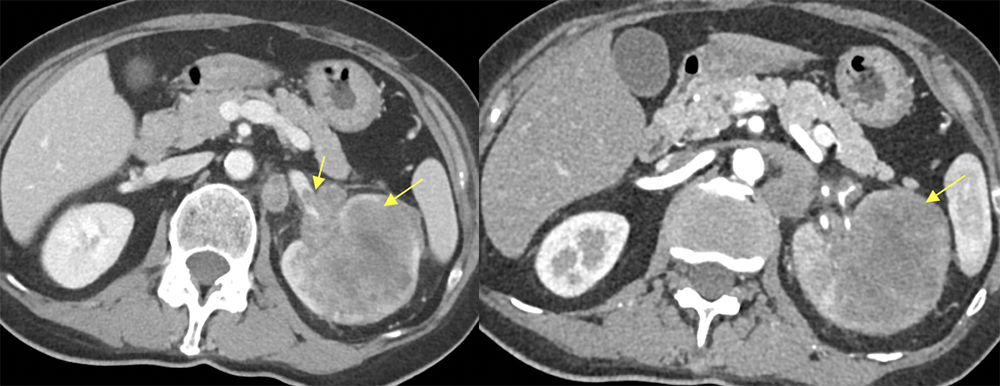 Transitional Cell Carcinoma