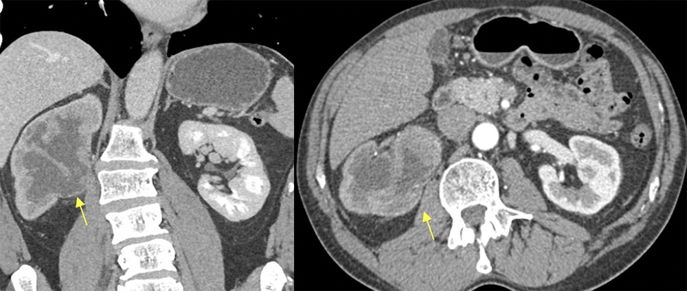 Transitional Cell Carcinoma