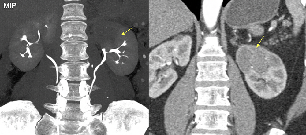 Transitional Cell Carcinoma
