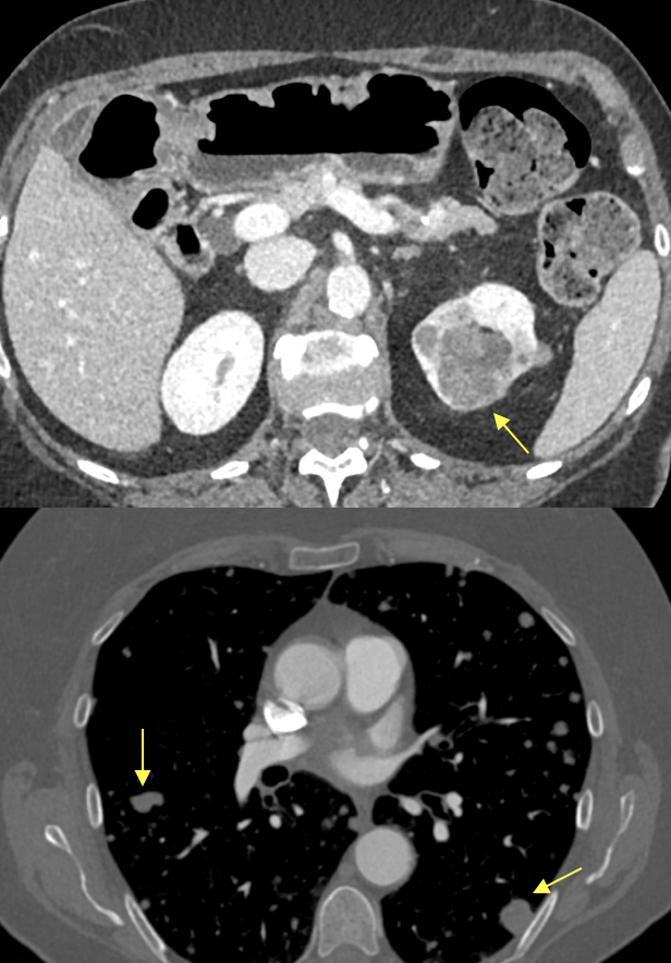 Transitional Cell Carcinoma