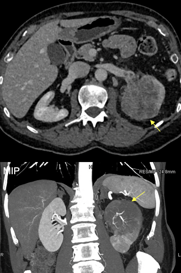 Transitional Cell Carcinoma