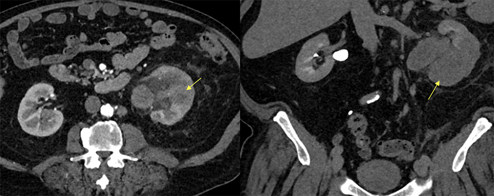 Transitional Cell Carcinoma