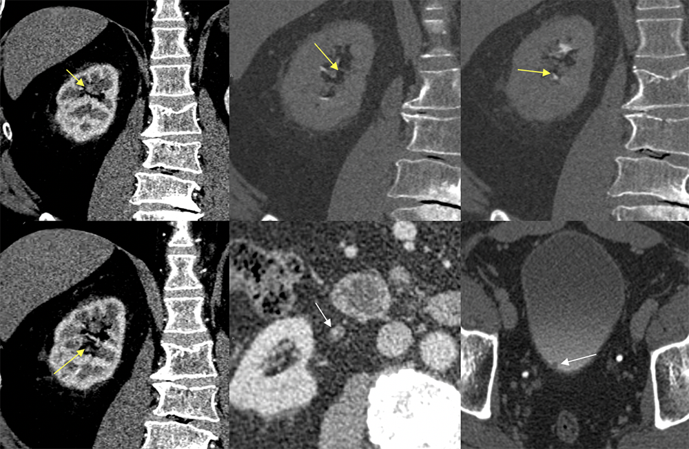 Multifocal UTUC on CTU