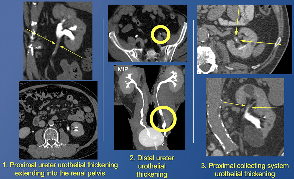UTUC as urothelial thickening on CTU