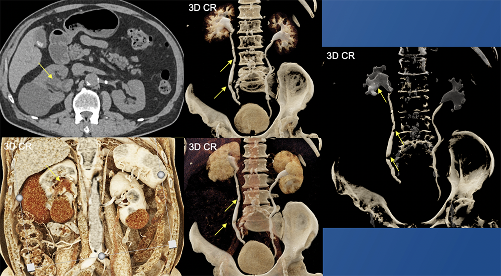 Transitional Cell Carcinoma