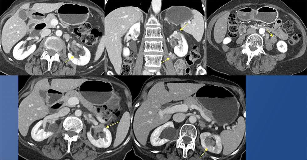Transitional Cell Carcinoma