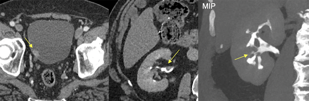 Transitional Cell Carcinoma