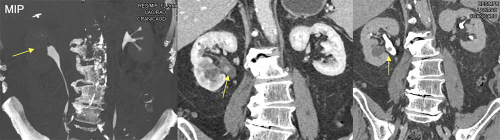 Transitional Cell Carcinoma