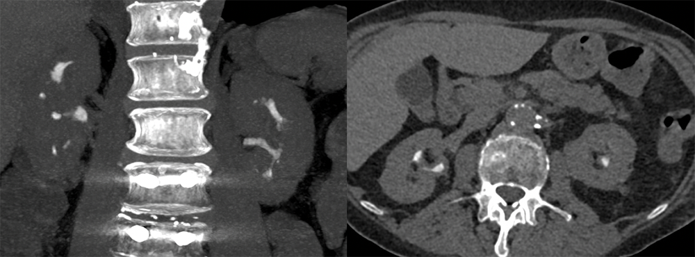 Transitional Cell Carcinoma