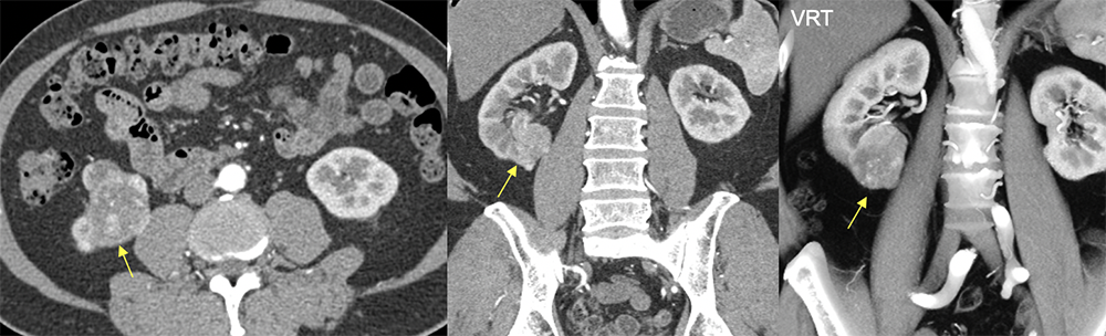 Transitional Cell Carcinoma