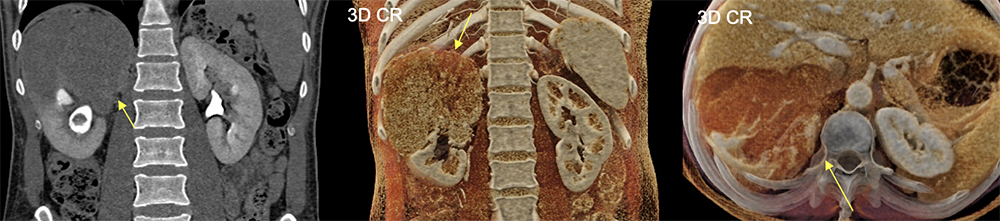Transitional Cell Carcinoma