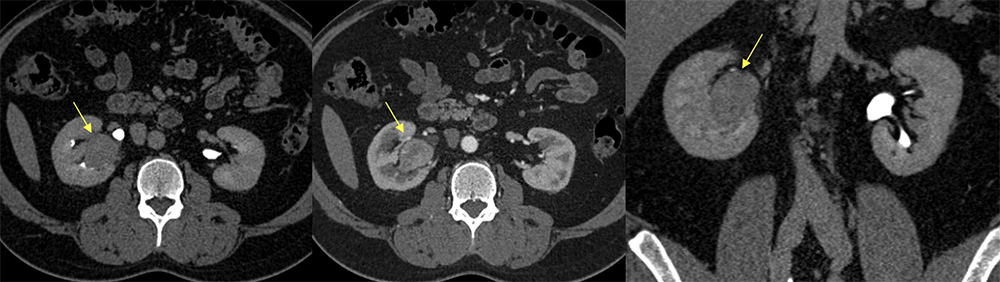 Transitional Cell Carcinoma