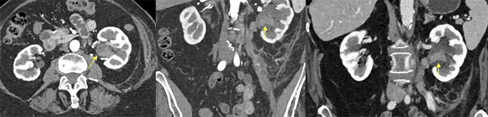 Transitional Cell Carcinoma