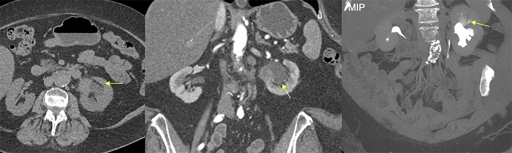 Transitional Cell Carcinoma