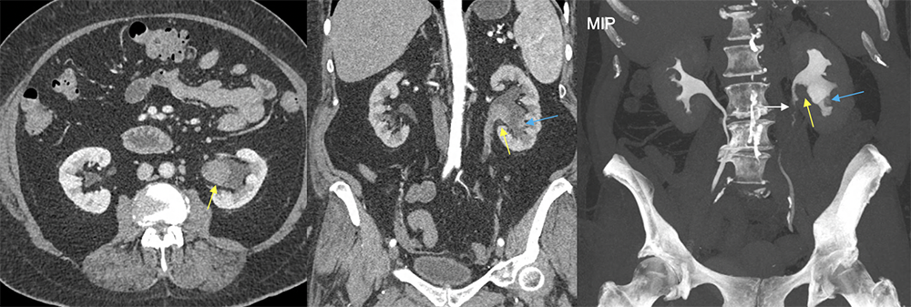 UTUC as enhancing mass involving the calyces on CTU