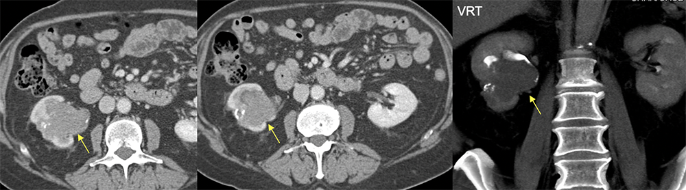 Transitional Cell Carcinoma