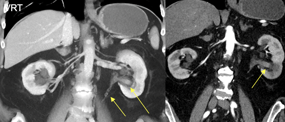 Transitional Cell Carcinoma