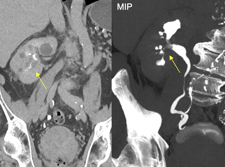 Transitional Cell Carcinoma