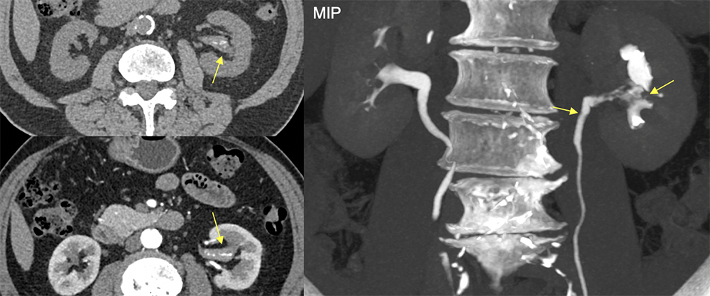 UTUC involving the renal pelvison CTU