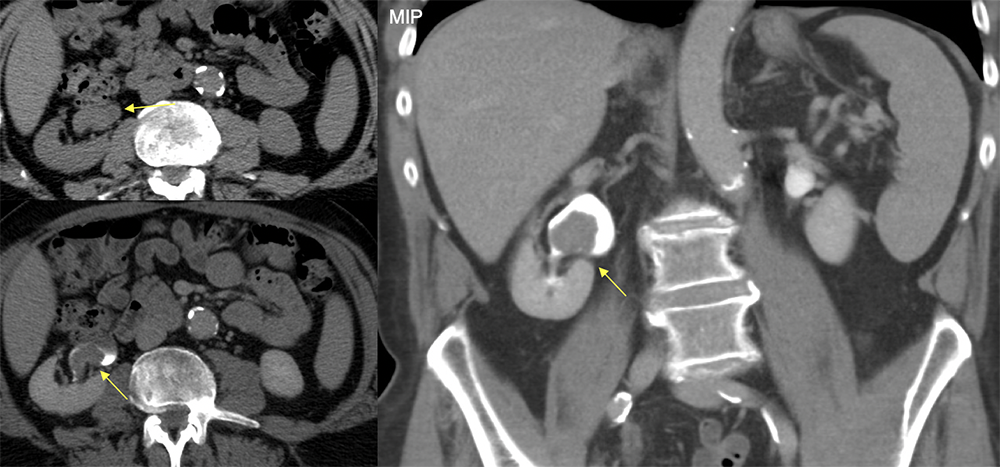 Transitional Cell Carcinoma