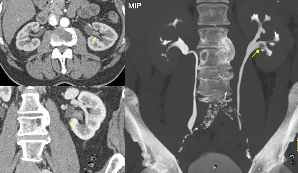 Transitional Cell Carcinoma