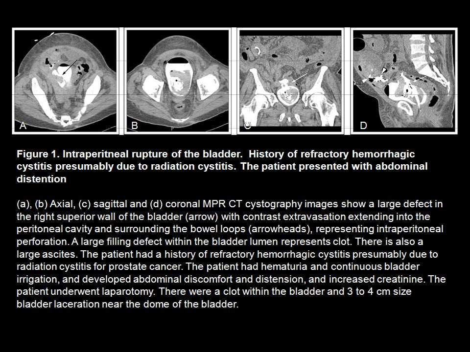 CT Cystography: The Role of 3D/MPR Imaging for Evaluation of Non-Neoplastic Disease of the Bladder