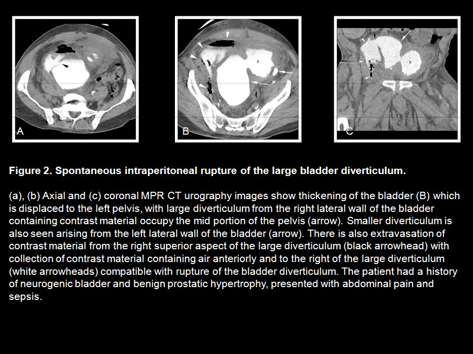 CT Cystography: The Role of 3D/MPR Imaging for Evaluation of Non-Neoplastic Disease of the Bladder