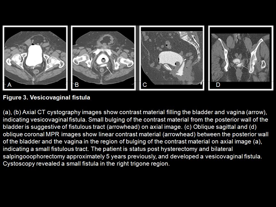 CT Cystography: The Role of 3D/MPR Imaging for Evaluation of Non-Neoplastic Disease of the Bladder