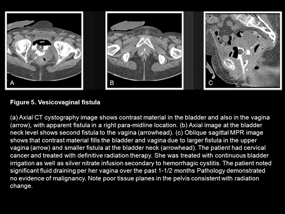 CT Cystography: The Role of 3D/MPR Imaging for Evaluation of Non-Neoplastic Disease of the Bladder