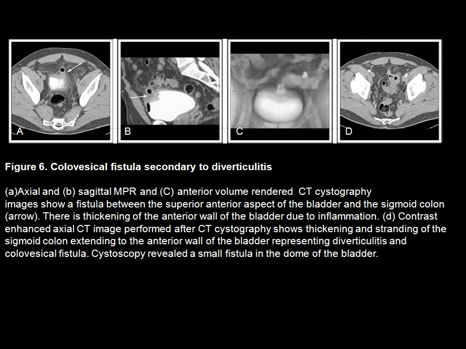 CT Cystography: The Role of 3D/MPR Imaging for Evaluation of Non-Neoplastic Disease of the Bladder